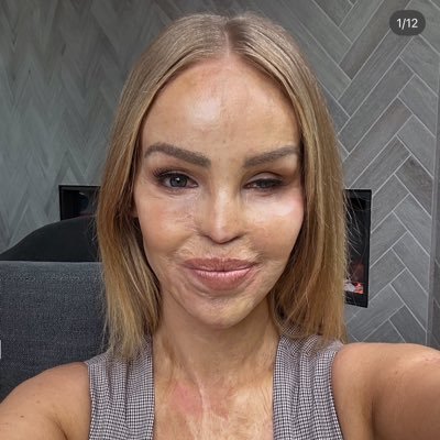 Katie Piper OBE